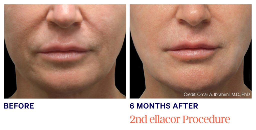 ellacor micro-coring technology - female before and 6 month after 2 skin tightening treatments around the mouth