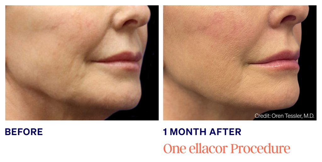 ellacor micro-coring technology - female before and 3 months after 1 skin tightening treatment around the mouth