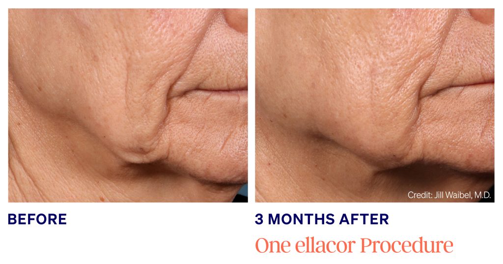 ellacor micro-coring technology - female before and 3 months after 1 skin tightening treatment to address jowls and sagging
