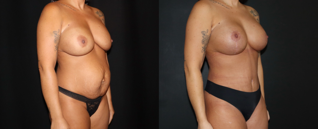Plastic Surgery After Ozempic: Your Guide to Body Contouring After GLP-1 Weight Loss in Charleston, SC - Crantford Costa Plastic Surgery, Charleston SC