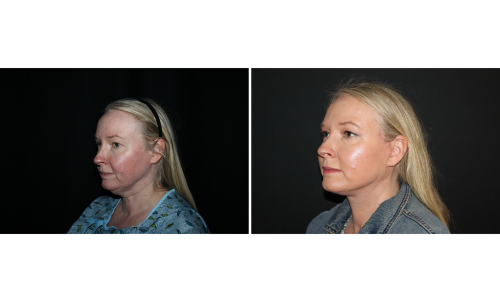 Side view before and after facelift to address skin laxity and soft tissue descent for a more youthful and refreshed facial contour, 50-year-old female patient, Charleston SC