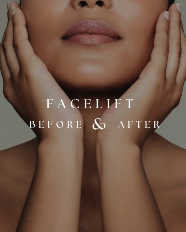 Refined, not overdone.  This patient underwent a deep plane facelift by Dr. Crantford to restore definition through the jawline and neck while preserving what makes her features uniquely hers.  The after shows a smoother contour, a cleaner jawline, and a natural lift that doesn’t read as surgical.  The intention is never to change your face, but to reposition and refresh what’s already there.  If you’ve been considering facial rejuvenation, schedule a consultation to learn what approach is right for you.