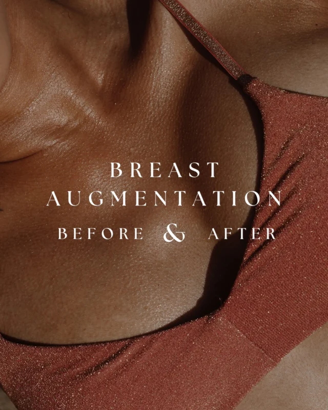 The drop and fluff is real.  After a breast augmentation by Dr. Crantford, it’s completely normal for implants to sit higher and feel firmer in the early weeks. At the 2 week mark, swelling and tight chest muscles can create a more elevated, rounded appearance.  As healing progresses, the implants begin to settle into their natural position. By around 2 months, the muscles have relaxed, swelling has improved, and the shape softens into a more natural contour.  Pre op to 2 weeks to 2 months shows the full evolution.  Patience during this phase is key, and the results are worth it.