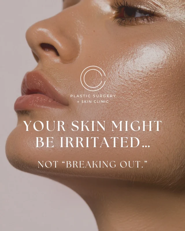 Sometimes what looks like acne, irritation, or “bad skin” is actually a compromised skin barrier.  Over-exfoliation, harsh active ingredients, and constantly switching products can leave skin inflamed, reactive, dehydrated, and more prone to breakouts over time.  Healthy skin should feel balanced, calm, and resilient, not constantly irritated.  A more effective routine is not always a more aggressive one.  Barrier support, hydration, SPF, and consistency often make the biggest difference long term.