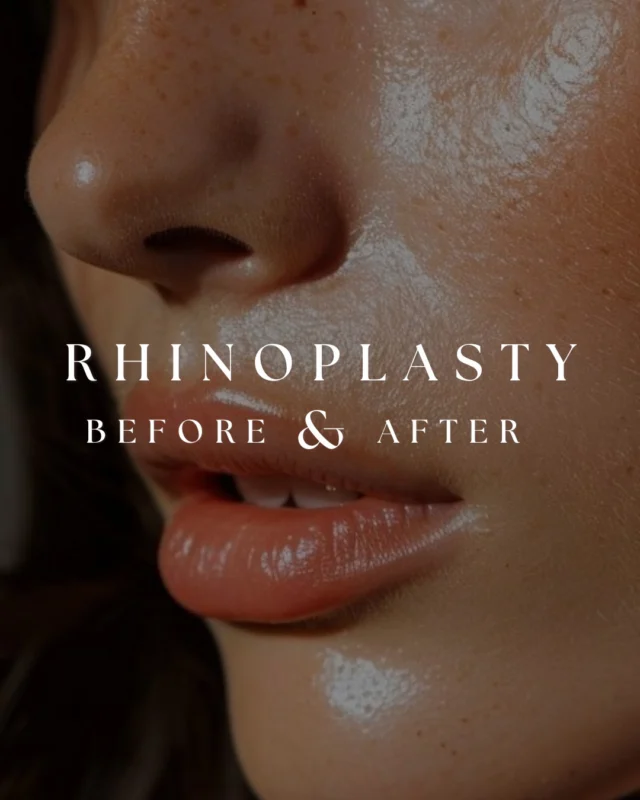 Refinement without losing character.  Rhinoplasty is one of the most individualized procedures in plastic surgery because every face requires a different approach.  The goal is never to create a completely different face. It’s to bring balance to the profile while preserving the features that make someone look like themselves.  Thoughtful changes. Natural results.