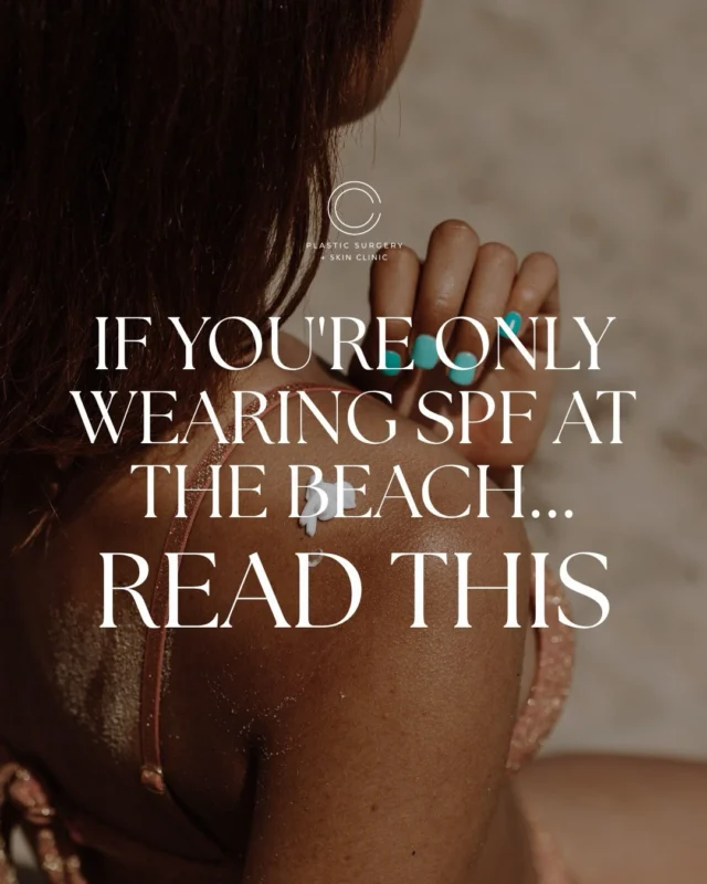 SPF is one of the few skincare products that helps protect the results you’re investing in every day.  Sun exposure plays a major role in collagen loss, pigmentation, texture changes, and visible signs of aging over time, and a large portion of that exposure happens during everyday activities, not just days spent at the beach.  A few things that surprise patients most:
• We often see more sun damage on the left side of the face from years of driving.
• SPF 30 and SPF 50 provide more similar protection than many people realize.
• The best sunscreen is the one you’ll wear consistently.  Small habits matter, especially when it comes to your skin.