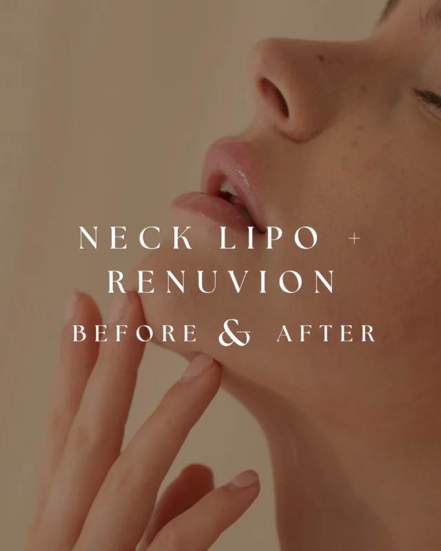 One week post-op.  Even with swelling still present, you can already see early improvement in the jawline and neck contour.  Neck liposuction removes excess fat beneath the chin and along the neck, while Renuvion® helps tighten the skin and support contour refinement during the healing process.  One of the most important things patients should know is that these results are still evolving. As swelling continues to improve and the skin contracts over the coming weeks and months, definition and contour become even more apparent.  Early result shown at 1 week post-op.
Procedure performed by Dr. Crantford.