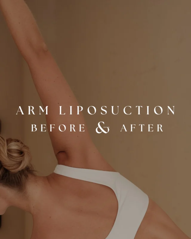 Many patients are surprised to learn that arm contouring isn't always about removing a significant amount of fat.  Often, it's about creating a smoother, more defined shape and improving the transition from the shoulder to the arm.  In this case, VASER liposuction was combined with Renuvion® technology to address both excess fat and skin laxity, helping create a more refined contour without the scars associated with a traditional arm lift.  Results continue to evolve as swelling improves and skin tightening progresses over the months following treatment.  Procedure performed by Dr. Crantford.