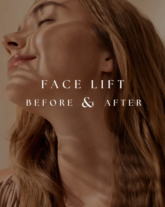 Fourteen days.  That's what makes this result so remarkable.  When people think about facelift recovery, they often imagine months before seeing meaningful improvement. In reality, many patients begin noticing changes much sooner.  Even with swelling still present, you can already see improved definition through the jawline, a smoother neckline, and a more rested appearance.  The healing process is far from over, which makes early results like these even more exciting. Over the coming months, swelling will continue to resolve and the tissues will continue to settle.  Procedure performed by Dr. Crantford.
