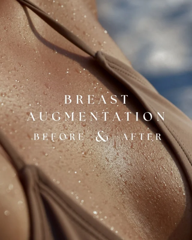 This result was photographed immediately after surgery.  Many people assume breast augmentation results take months before they begin looking natural, but a lot of what patients are seeing in before-and-after photos starts with thoughtful planning long before the procedure itself.  Implant selection, proportions, anatomy, tissue characteristics, and surgical technique all play a role in creating a result that feels balanced and natural.  Of course, healing is still an important part of the process. Swelling, settling, and tissue relaxation will continue over the weeks and months ahead.  Even so, immediate results like these offer a glimpse into the foundation that was created in surgery.  Procedure performed by Dr. Crantford.